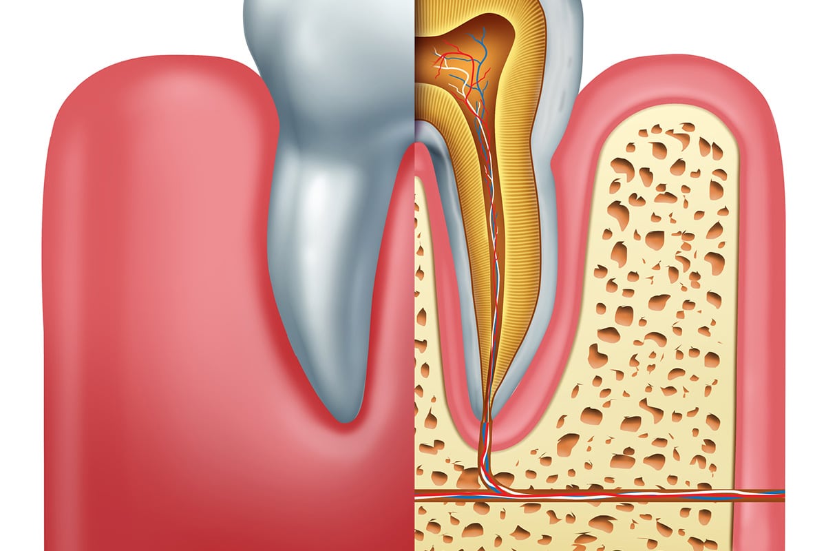 how-long-can-you-go-without-getting-a-root-canal